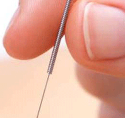 Can Dry Needling Help with Neurological Conditions?