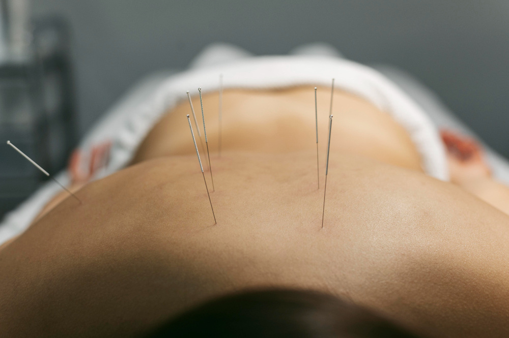 dry-needling-physical-Therapy-By-Phoenix-Wichita-Hutchinson-KS (1)